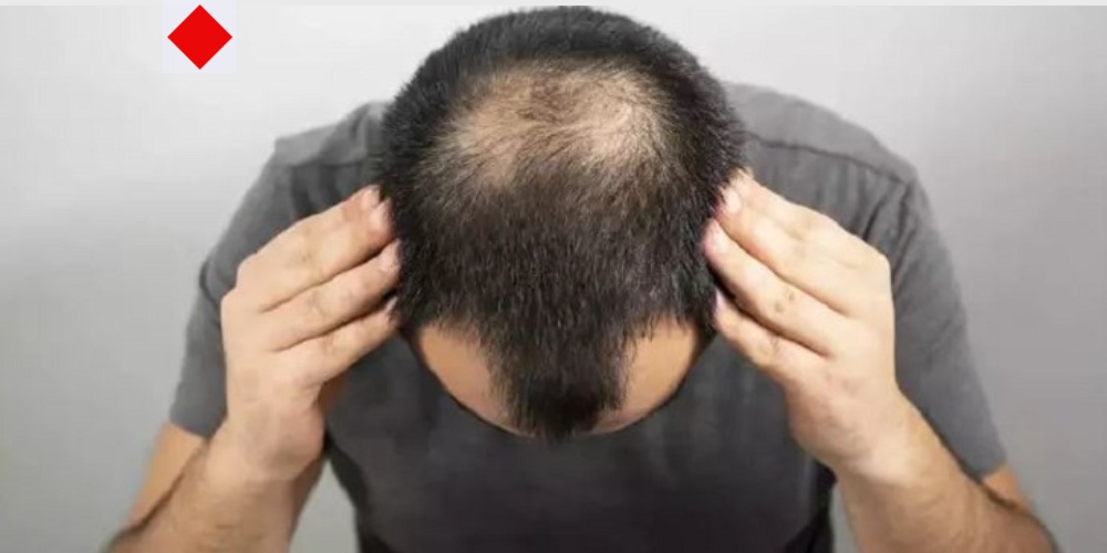 টাক মাথায় চুল গজানো সম্ভব কি? সত্যিই কি নতুন চুল জন্মায়?