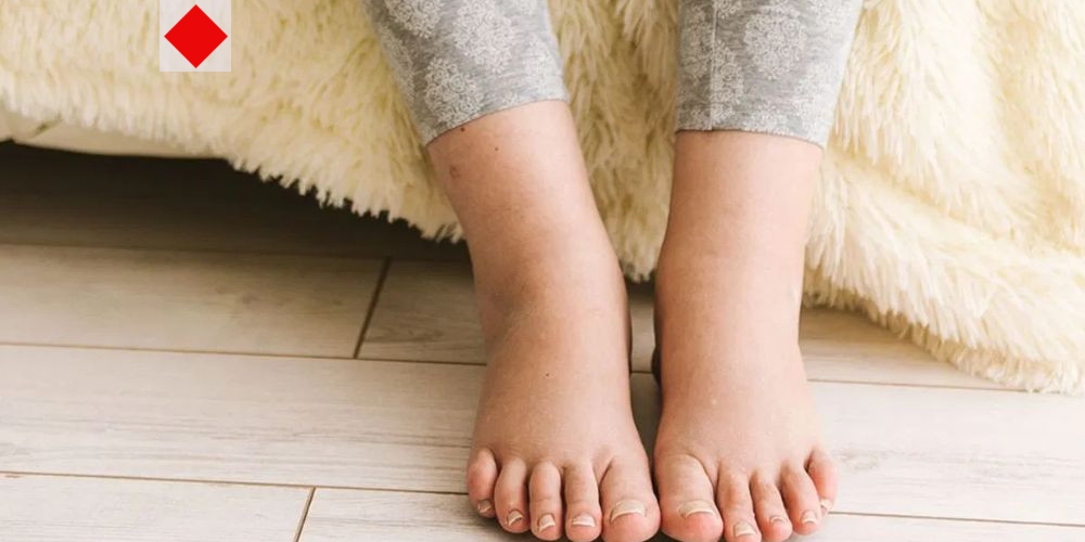 দীর্ঘক্ষণ বসে থাকলে পা ফোলে? সহজ প্রতিরোধের উপায় জানুন