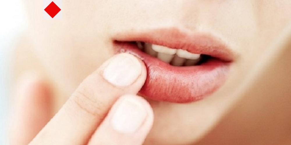 শীত আসার আগেই ঠোঁট ফাটছে? সহজ কিছু ঘরোয়া সমাধান