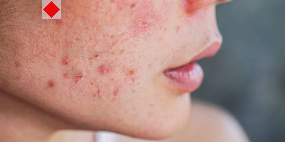 প্রাকৃতিক উপায়ে ব্রণের দাগ দূর করবেন যেভাবে