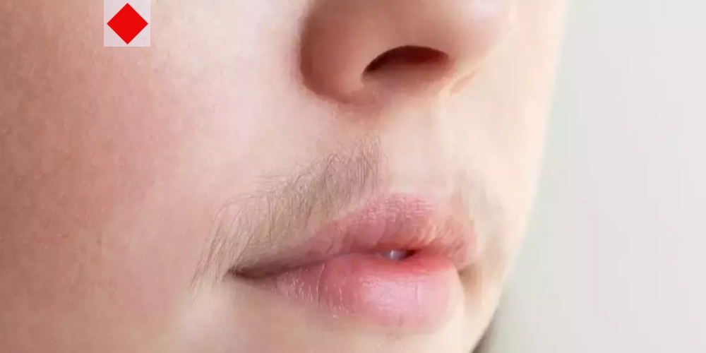 অবাঞ্ছিত লোমে মুখের সৌন্দর্য ম্লান হচ্ছে?